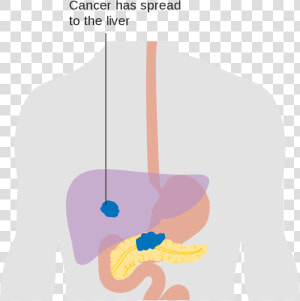 Illustration Pancreatic Cancer  HD Png Download