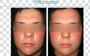 Picture3   Acne Cosmetica  HD Png Download