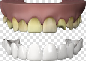 Press On Veneers Teeth   Fang  HD Png Download