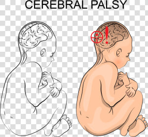 How Can I Tell If My Child Has Cerebral Palsy   Cerebral Palsy Illustration  HD Png Download