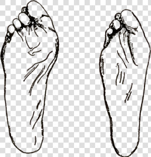 Fig46 Deformities Of Feet Resulting From Bad Shoes  HD Png Download