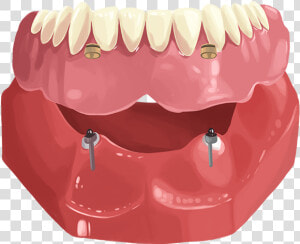 Dentures  HD Png Download