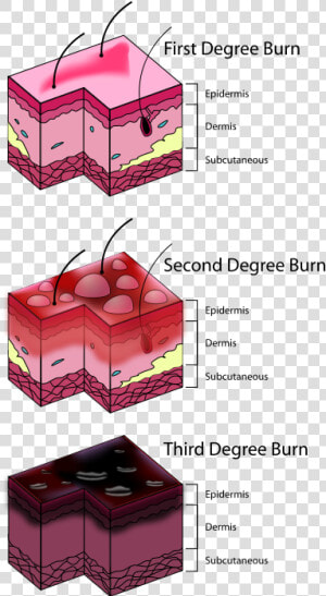 First Degree Rope Burn  HD Png Download