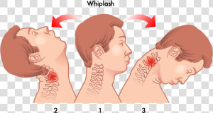 Head Neck Whiplash   Whiplash Injury  HD Png Download