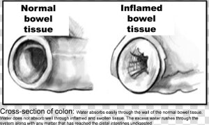 Inflamed Bowel  HD Png Download