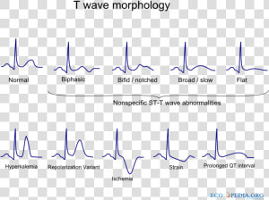 De t Wave Morphology   T Wave Morphology  HD Png Download