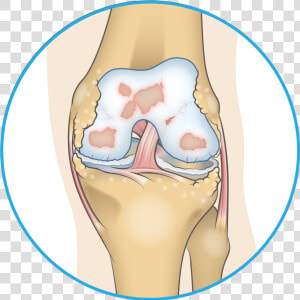 Bone Spur In Knee  HD Png Download