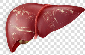 Liver Png Page   Chronic Liver With Hepatitis B  Transparent Png