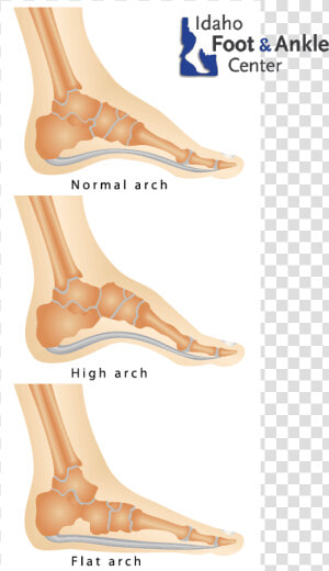 Flat Feet  amp  Other Foot Deformities   Fallen Foot Arch  HD Png Download