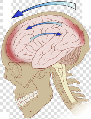 Concussion  Whiplash  amp  Migraine Related Injuries   Primary Brain Injury  HD Png Download