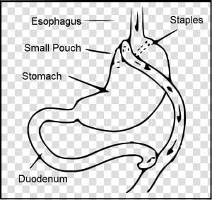 Roux En Y Gastric Bypass   Type Two Diabetes Drawing  HD Png Download