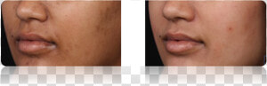 Acne   Scar  HD Png Download