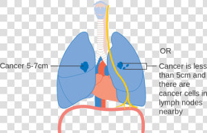 Stage 1 Early Stage Lung Cancer  HD Png Download