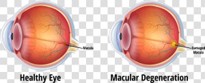 Blindness Caused By Glaucoma  HD Png Download