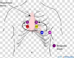 Brugada Syndrome Ecg Placement  HD Png Download