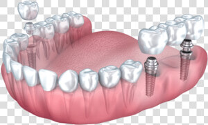 Dental Implant Benefits Summit Nj   Multiple Dental Implants  HD Png Download