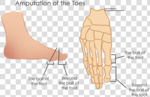 Transparent Toes Png   Partial Amputation Of Toe  Png Download