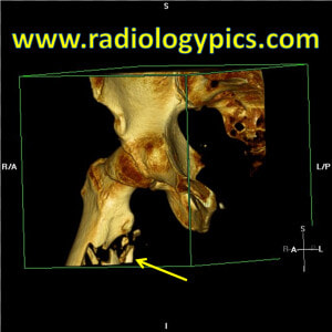 Subtrochanteric Femur Fracture   Computed Tomography  HD Png Download