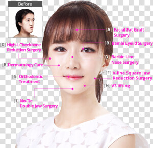  hospital Perfect Makeover Plan   Bambi Eyelid Surgery  HD Png Download