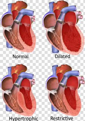 Major Categories Of Cardiomyopathy   Different Cardiomyopathies  HD Png Download