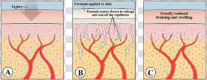 Bruise Repair Formula   Bruises How They Are Formed  HD Png Download