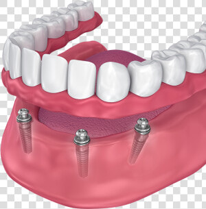 All On 4 Lower Denture   Implant Supported Denture  HD Png Download