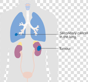 Kidneys Png   Png Download   Secondary Lung Tumor  Transparent Png