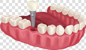 Dental Implant For Diabetics  HD Png Download