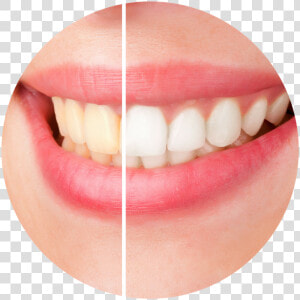 Before And After Teeth Whitening  HD Png Download