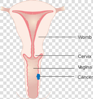 Diagram Showing Stage 1 Vaginal Cancer Cruk   Symmetry  HD Png Download