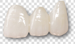 Dental Bridges Preston   Layered Zirconia Crown  HD Png Download