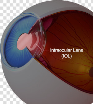 A Diagram Of An Eye With An Intraocular Lens   Intraocular Lens  HD Png Download