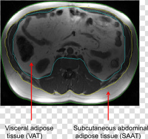 V Fat   Computed Tomography  HD Png Download