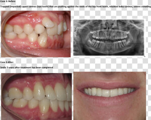 Bad Teeth Braces Before And After  HD Png Download