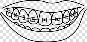 Collection Of With   Teeth With Braces Coloring Pages  HD Png Download