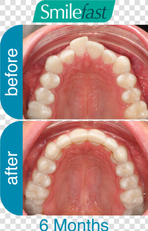 Aqd Smilefast After 6 months   Fast Braces Buck Teeth Before And After  HD Png Download