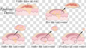 © 2010 Terese Winslow   Skin Cancer Treatment  HD Png Download