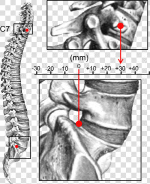 Sagittal Balance   Kyphosis  HD Png Download