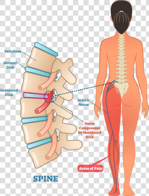 Left Side Sciatic Nerve Pain  HD Png Download