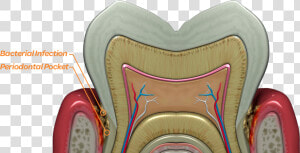 Bacteria Thrive Deep Below The Gum Line In The Periodontal   Tooth  HD Png Download