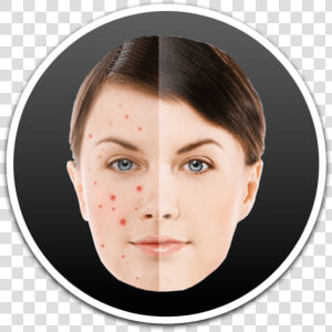 How To Remove Pimples And Blemish From Photos On Mac   Acne  HD Png Download