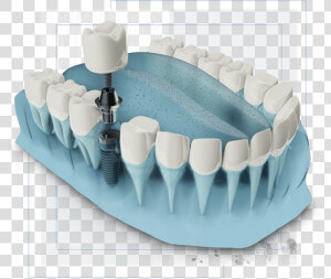 Dental Implants Graphic   Dental Implant  HD Png Download