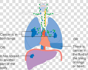 Stage 4 Lung Cancer Diagram  HD Png Download