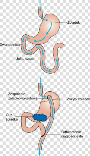 Diagram Showing Before And After Stomach Bypass Surgery  HD Png Download