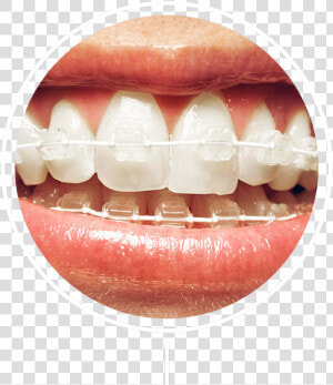 White And Silver Braces  HD Png Download