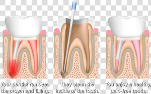 Root Canal Therapy  HD Png Download