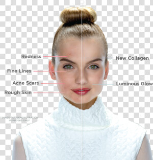 Portrait Photo With Left Side Of Face Before Treatment    Laser Facial Treatment  HD Png Download