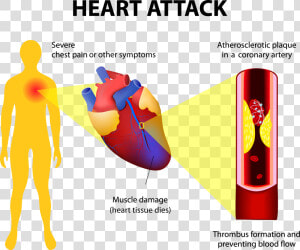 Heart attack2 Adobestock   Heart Chest Pain  HD Png Download