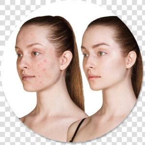 Galvanic Facial Treatment Before And After  HD Png Download