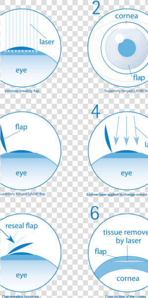 Transparent Procedure Png   Eye Laser Surgery Steps  Png Download